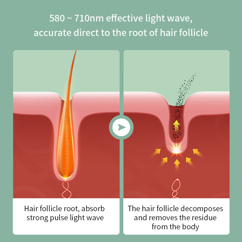 SilkSmooth - smärtfri laser för silkeslen hud